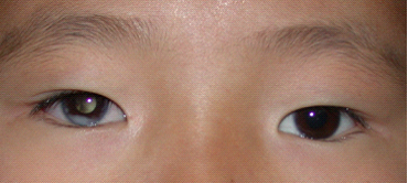 正常情况下人的瞳孔,也就是瞳仁是黑色的,在明亮的环境下自然缩小,在