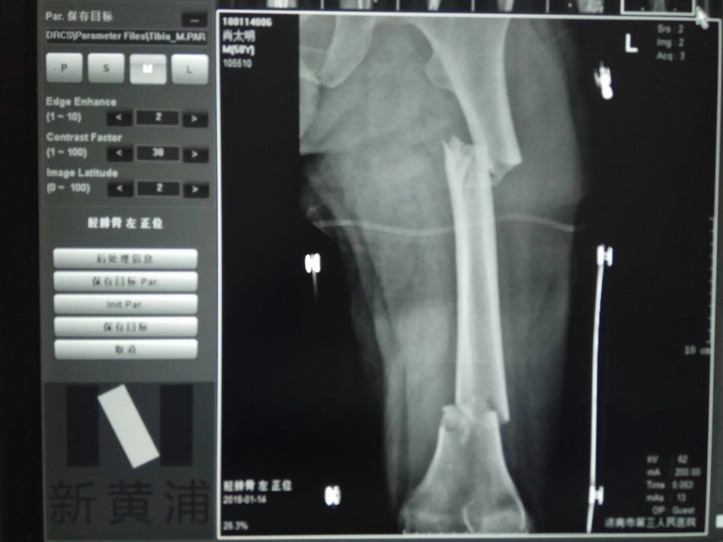 复杂的股骨粗隆间骨折PFNa固定一例(PFNa017) - 上海开为医药科技有限公司--创伤、肢体矫形技术解决方案的专业服务商