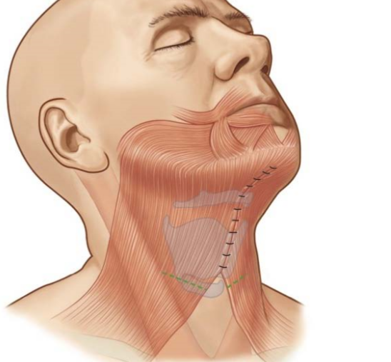 颈阔肌解剖图图片