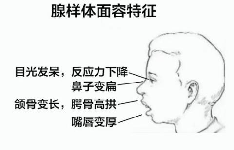 孩子睡覺打鼾,反覆感冒,關注扁桃體和腺樣體肥大不能等