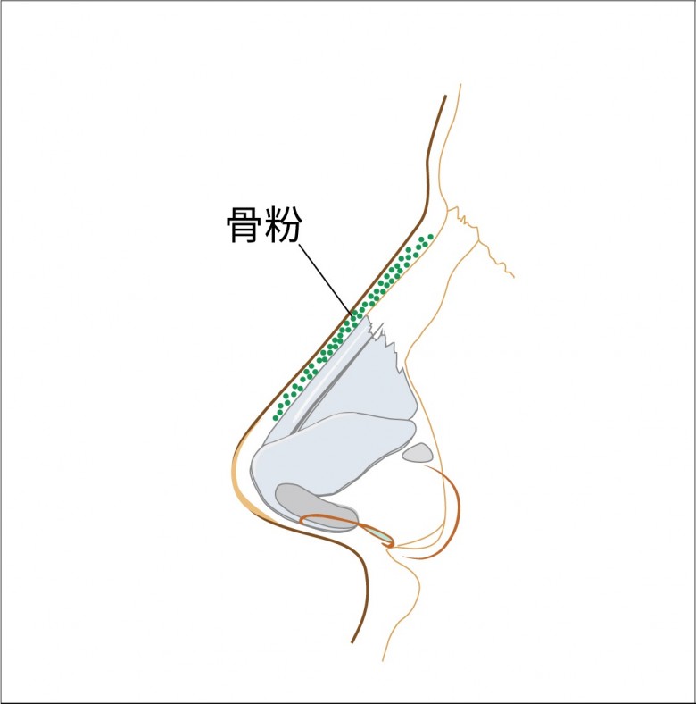 隆鼻用的骨粉注射在鼻背部位置