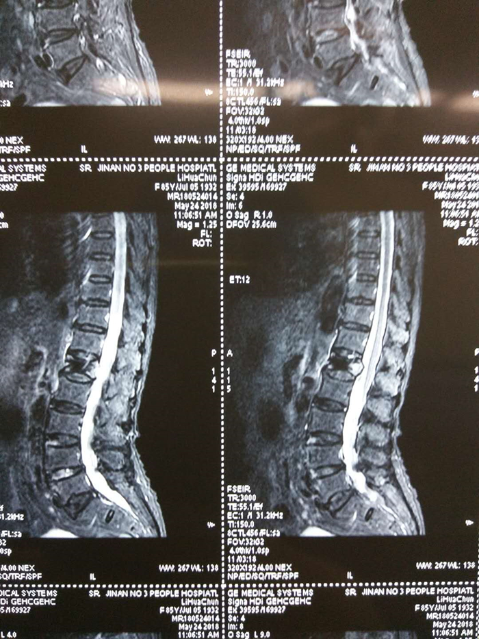 微手术大趋势:9旬老人骨质疏松骨折,经皮椎体后凸成形术解除病痛