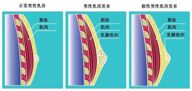 夏天到了,你是否还受男性乳房发育症的困扰?乳腺专家来告诉你怎么规避