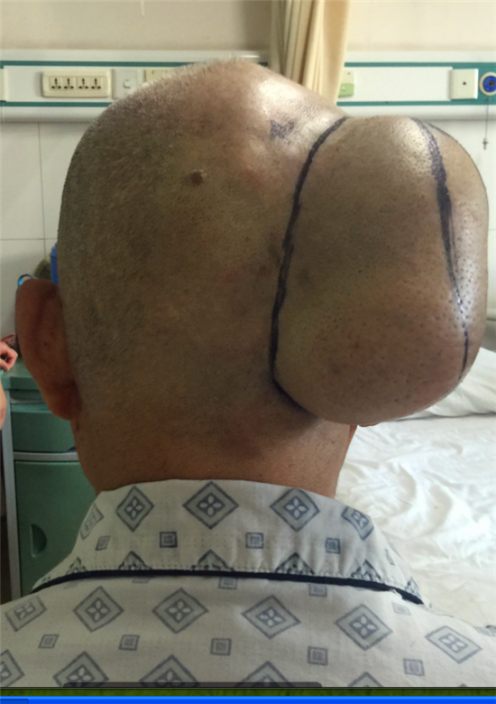 我院神经外科成功实施了头皮巨大肿物切除手术